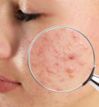 אקנה ופצעים בפנים: סוגים ושיטות טיפול-תמונה